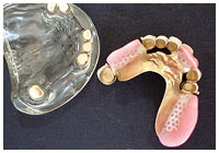 ニュー・テレスコープ義歯のイメージ